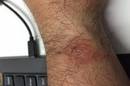 Fitbit scabs