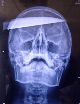 X-ray of gamer with knife in skull