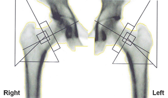 Hips X-ray