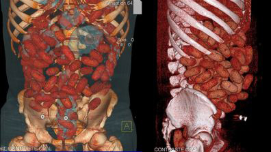 Scan showing bags of cocaine inside Irishman's abdomen