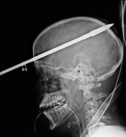 X-ray of three-foot spear going through Yasser Lopez's brain