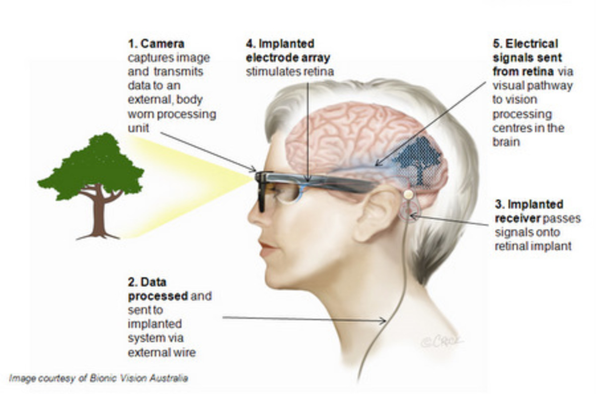 flowchart os x eye bionicâ€™ blind â€¢ The in patient â€˜Pre implanted Register