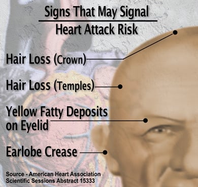 Looking old increases risk of heart disease