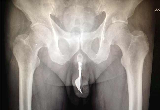 An X-ray of the fork inside the patient's penis. Image: The International Journal of Surgery
