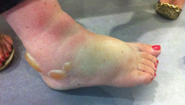 Nicola's swollen foot after the spider attack