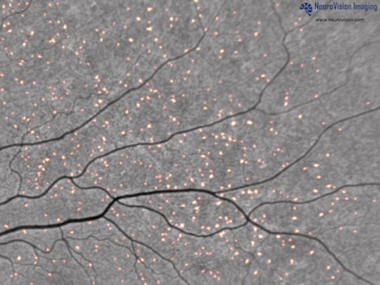 Plaques in the retina fluorescing in a scan