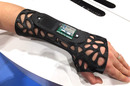 Osteoid cast modified to become the Intel Smart Splint