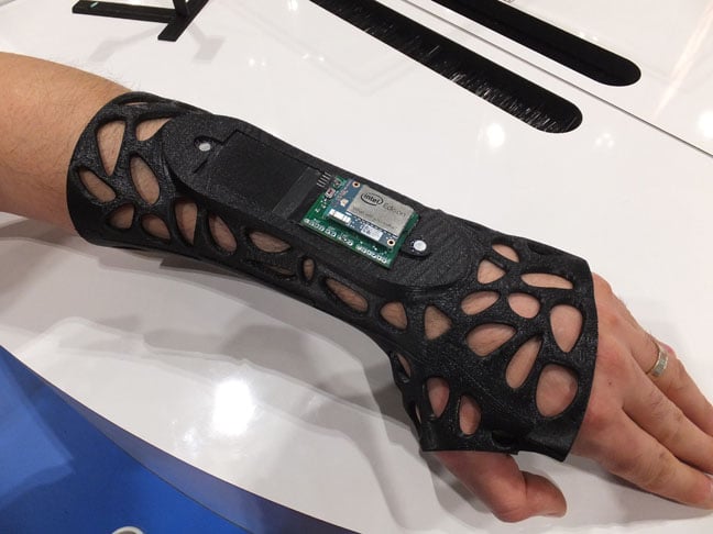 Osteoid cast modified to become the Intel Smart Splint