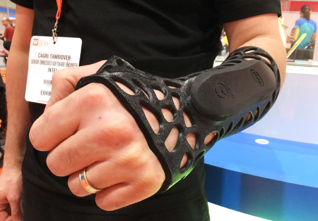 Osteoid cast modified to become the Intel Smart Splint