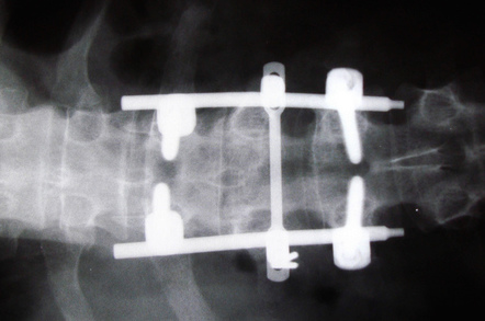 titanium rods in https://www.flickr.com/photos/warrenski/'s spine cc 2.0 attribution sharealike https://creativecommons.org/licenses/by-sa/2.0/