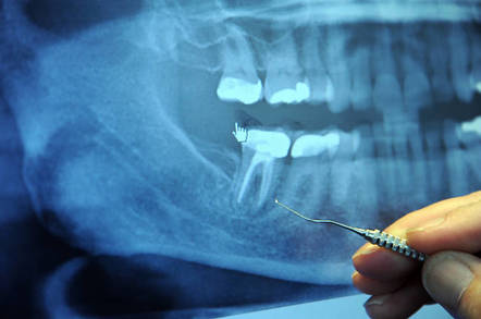 Dr. Alan Carr points out the broken root or bad root canal of a right rear molar (tooth), dental tool, orthodontist's office, full jaw Xray, Factoria, Washington, USA by https://www.flickr.com/photos/wonderlane/ cc 2.0 attribution https://creativecommons.org/licenses/by/2.0/