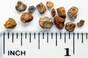 Kidney stones and a ruler