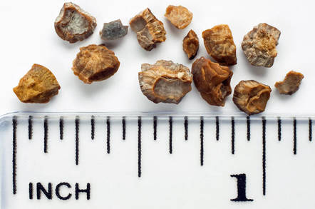 Kidney stones and a ruler