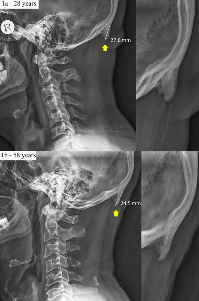 X-rays of skulls comparing bone length