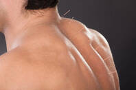man gets acupuncture in back