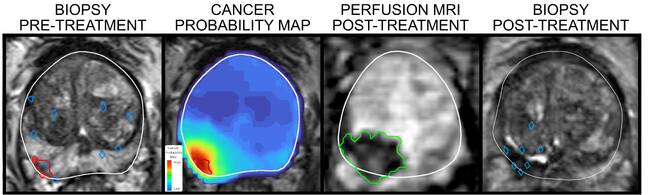 AI laser probe for prostate cancer enters clinical trials
