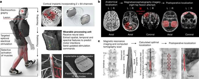 Figure 1 from paper: Walking naturally after spinal cord injury using a brain–spine interface