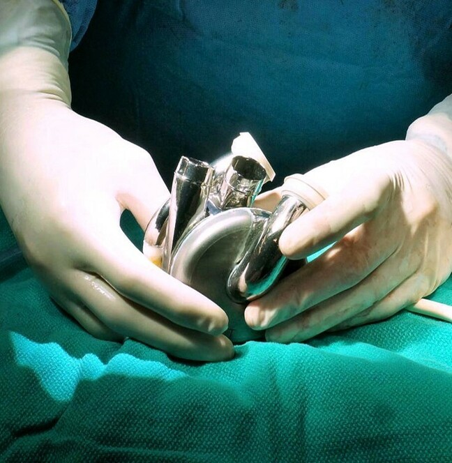 BiVACOR Total Artificial Heart surgery. Credit: BiVACOR